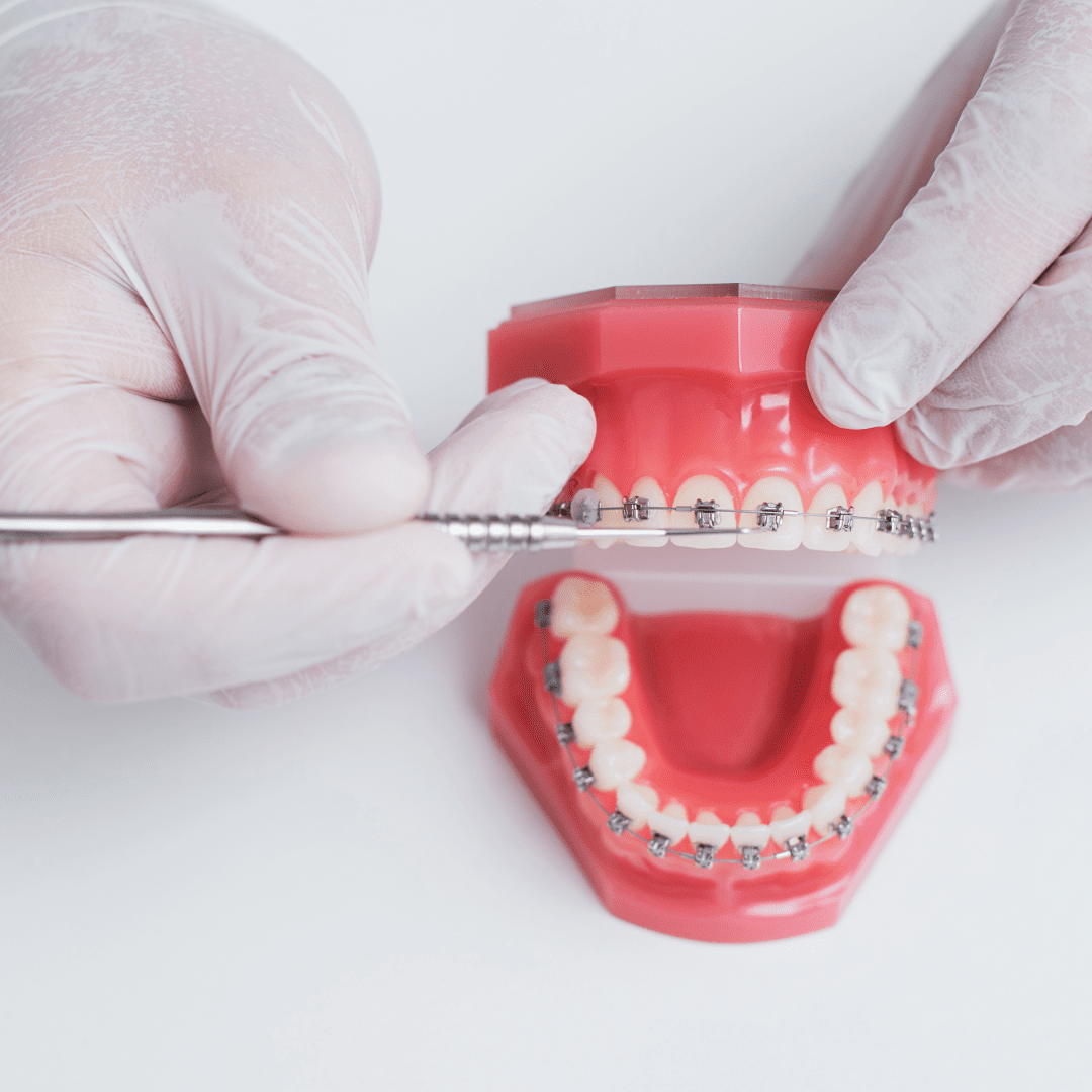 Ortodoncia: La Especialidad de la alineación dental
